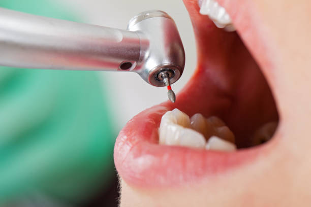 Best Emergency Dentist for Lost Fillings or Crowns in Ronkonkoma, NY